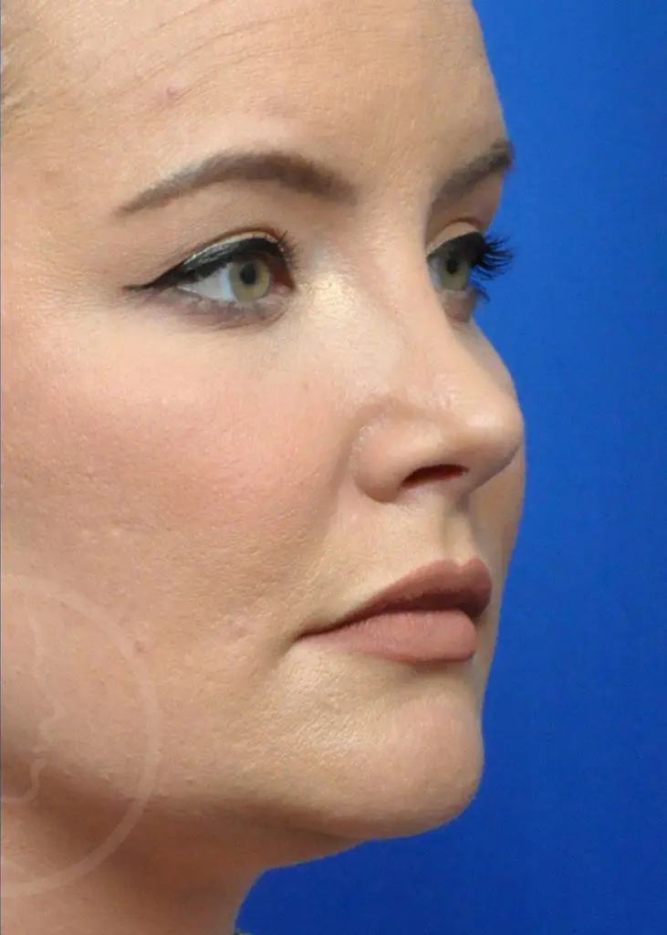 Plastic Surgery Before and After Pictures in Jacksonville, FL - Garcia Facial Plastic Surgery