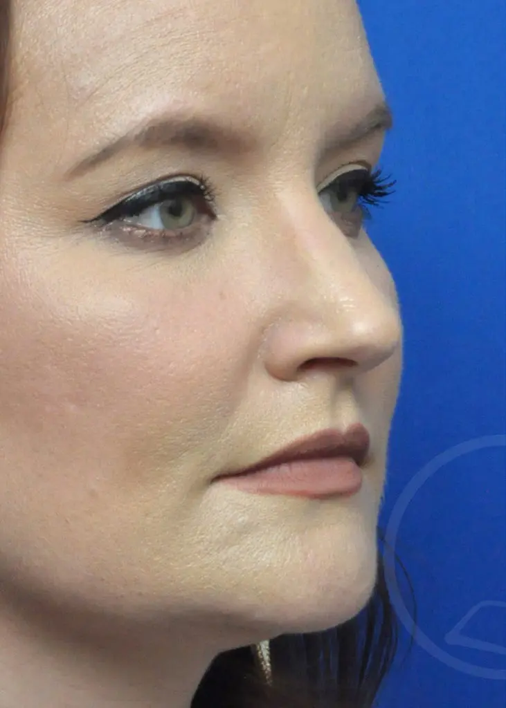 Plastic Surgery Before and After Pictures in Jacksonville, FL - Garcia Facial Plastic Surgery