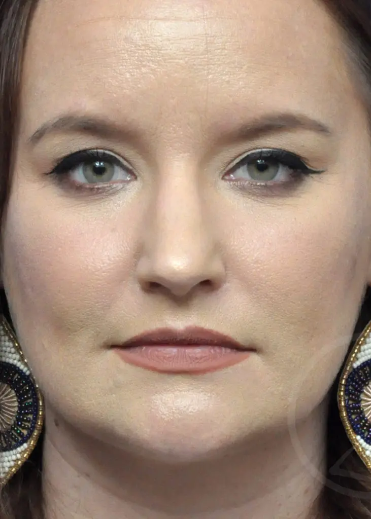 Plastic Surgery Before and After Pictures in Jacksonville, FL - Garcia Facial Plastic Surgery