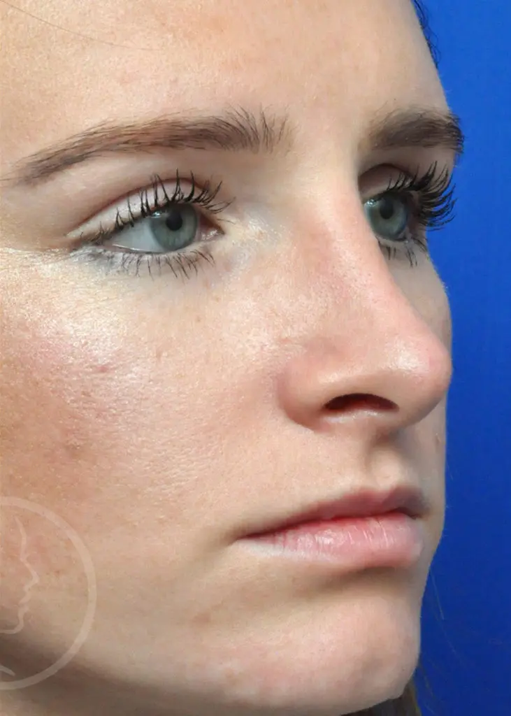 Plastic Surgery Before and After Pictures in Jacksonville, FL - Garcia Facial Plastic Surgery