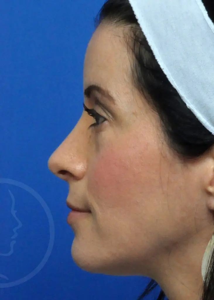 Plastic Surgery Before and After Pictures in Jacksonville, FL - Garcia Facial Plastic Surgery