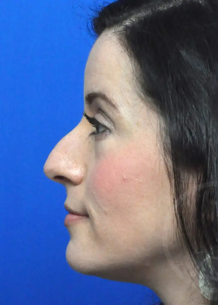 Plastic Surgery Before and After Pictures in Jacksonville, FL - Garcia Facial Plastic Surgery