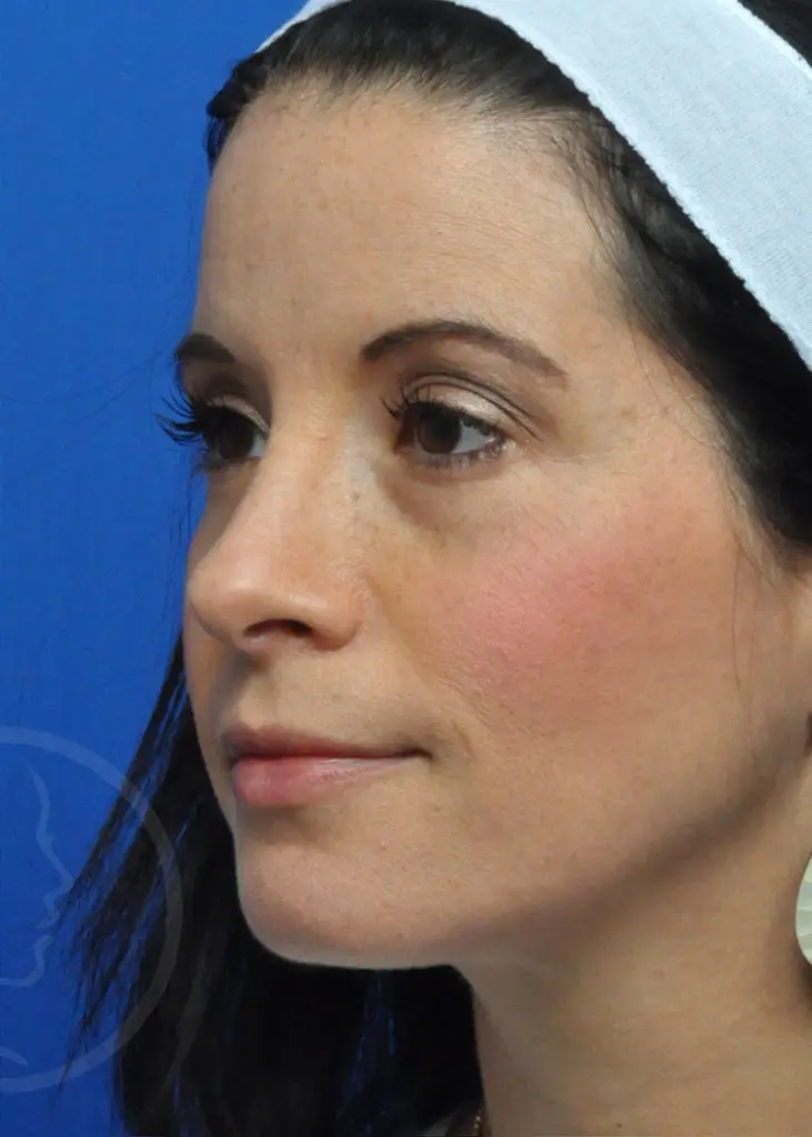 Plastic Surgery Before and After Pictures in Jacksonville, FL - Garcia Facial Plastic Surgery