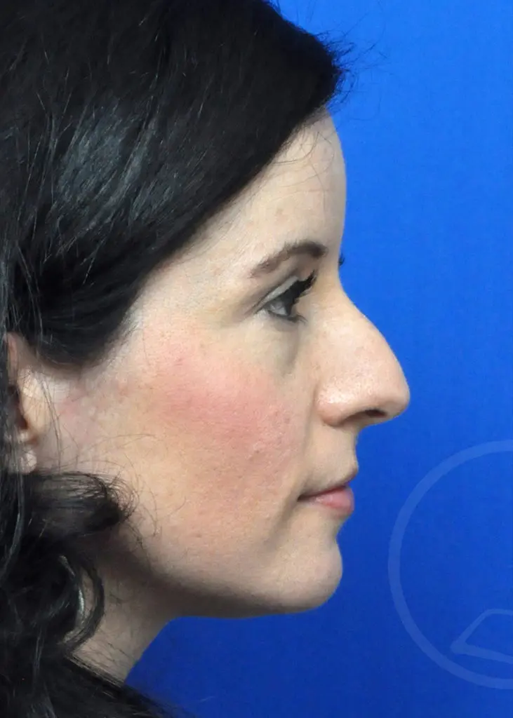 Plastic Surgery Before and After Pictures in Jacksonville, FL - Garcia Facial Plastic Surgery