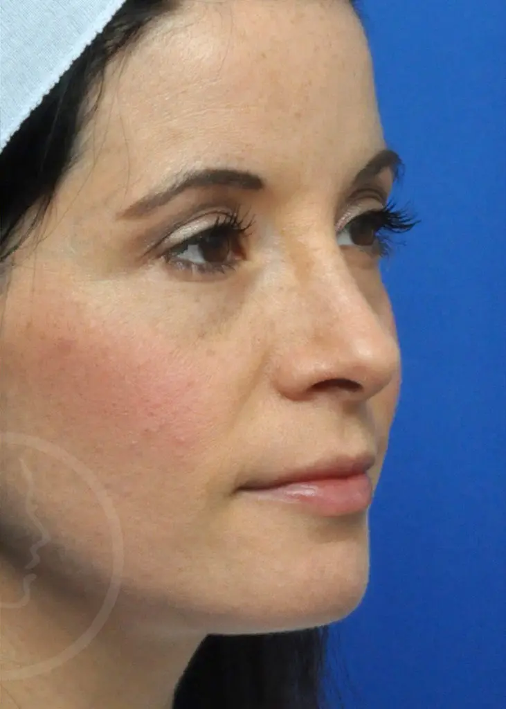 Plastic Surgery Before and After Pictures in Jacksonville, FL - Garcia Facial Plastic Surgery