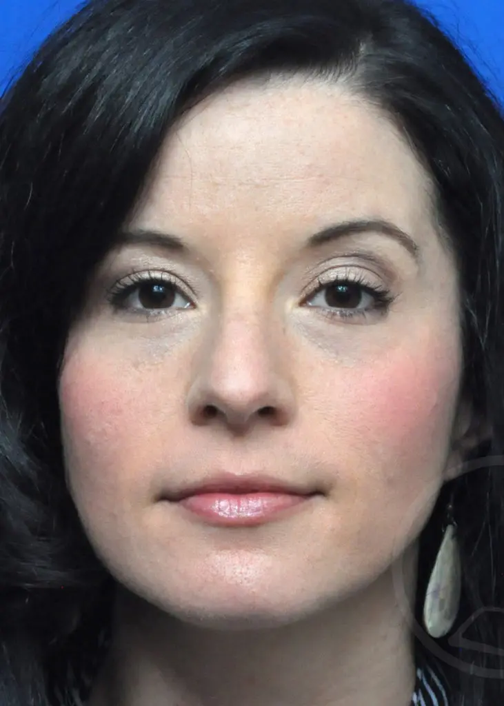 Plastic Surgery Before and After Pictures in Jacksonville, FL - Garcia Facial Plastic Surgery