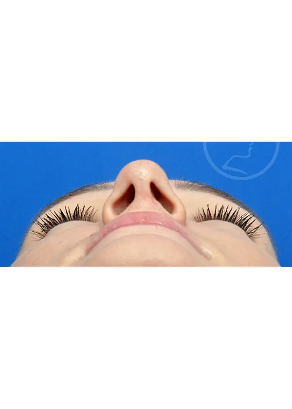 Plastic Surgery Before and After Pictures in Jacksonville, FL - Garcia Facial Plastic Surgery