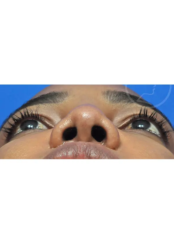 Plastic Surgery Before and After Pictures in Jacksonville, FL - Garcia Facial Plastic Surgery