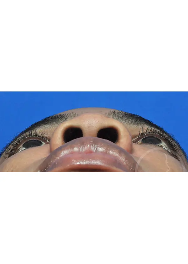 Plastic Surgery Before and After Pictures in Jacksonville, FL - Garcia Facial Plastic Surgery