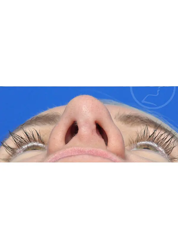 Plastic Surgery Before and After Pictures in Jacksonville, FL - Garcia Facial Plastic Surgery