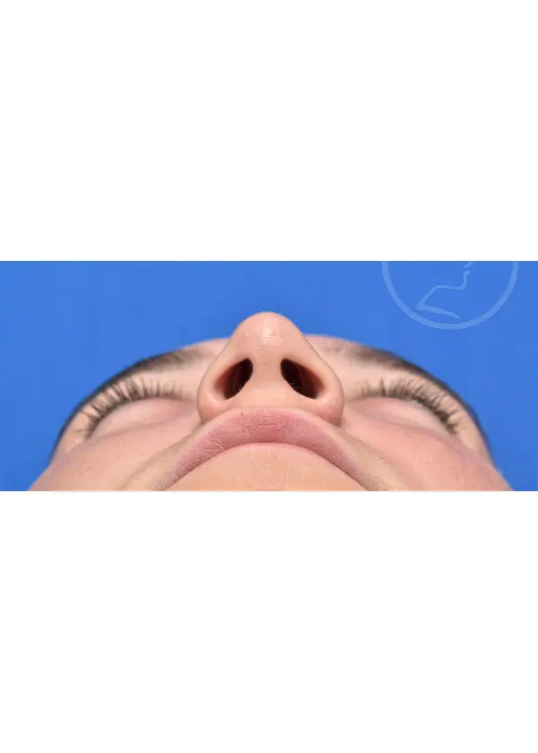 Plastic Surgery Before and After Pictures in Jacksonville, FL - Garcia Facial Plastic Surgery