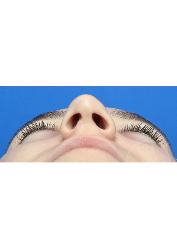 Plastic Surgery Before and After Pictures in Jacksonville, FL - Garcia Facial Plastic Surgery