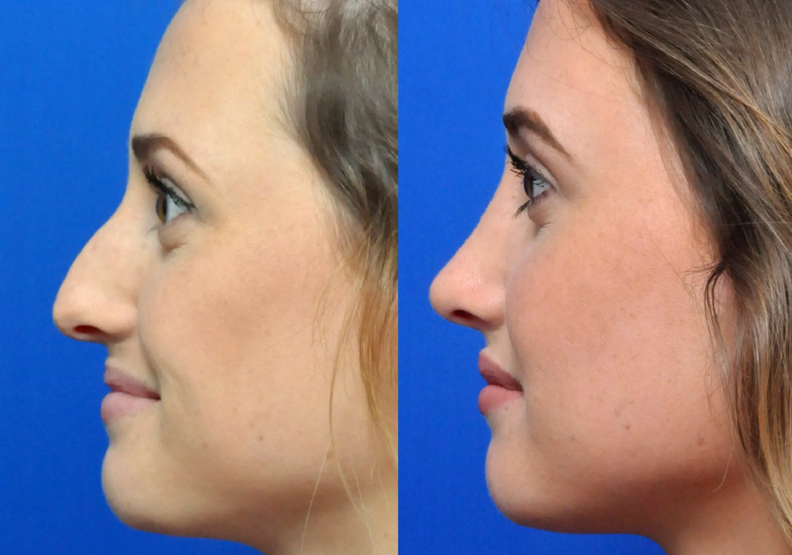 Rhinoplasty in Jacksonville, FL
