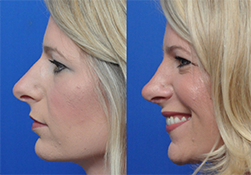 Rhinoplasty in Jacksonville, FL