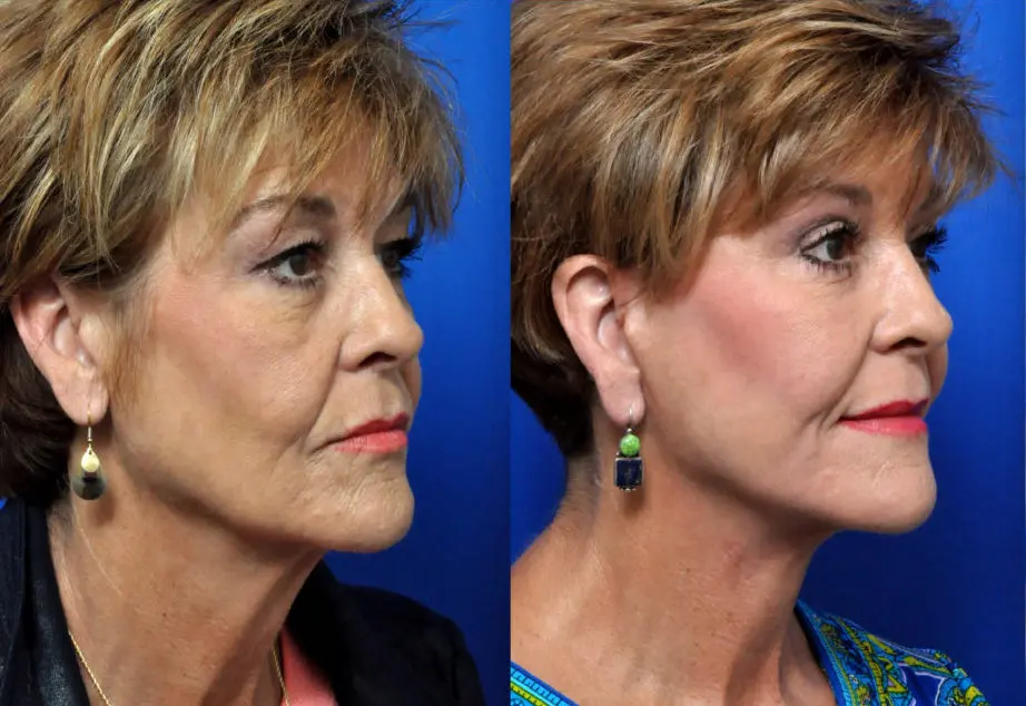 Facelift in Jacksonville, FL