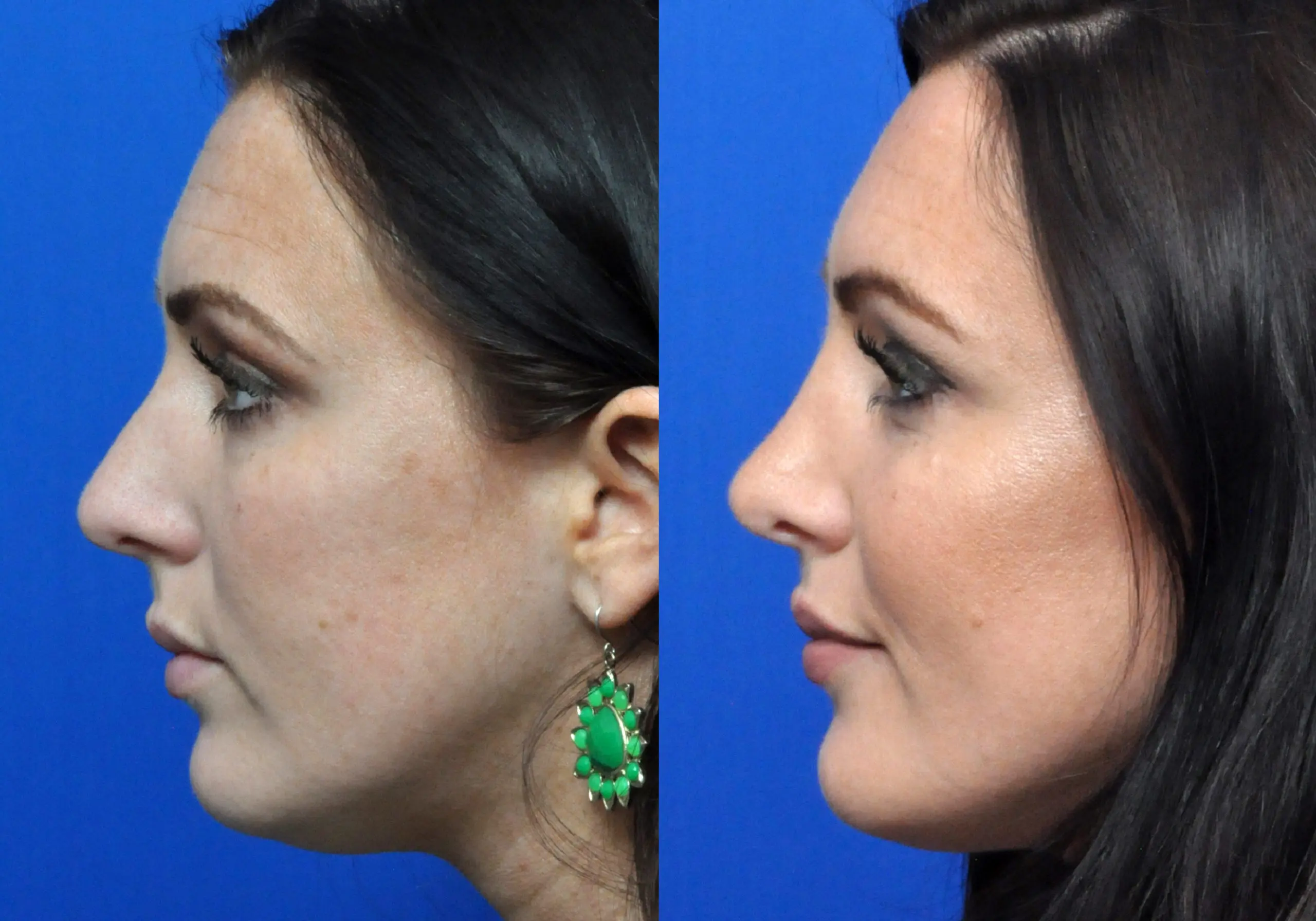 Rhinoplasty in Jacksonville, FL