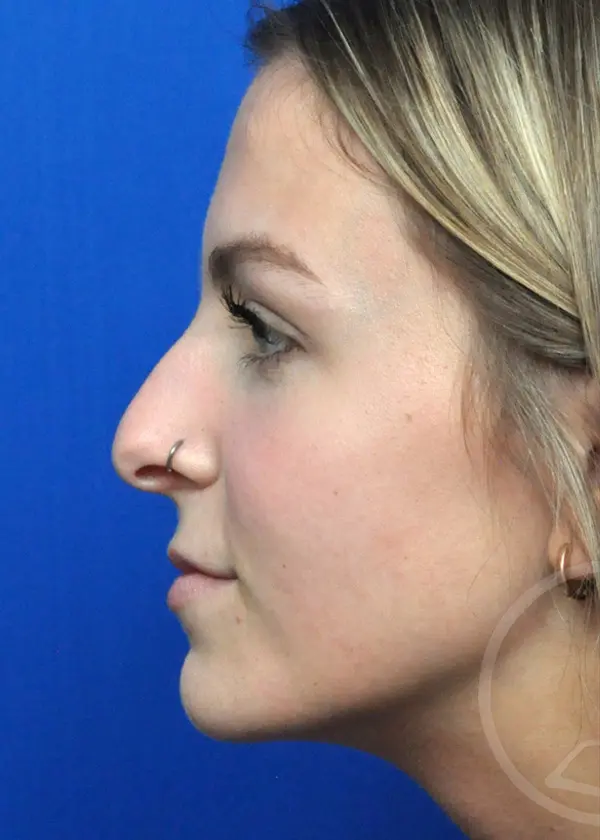 Plastic Surgery Before and After Pictures in Jacksonville, FL - Garcia Facial Plastic Surgery