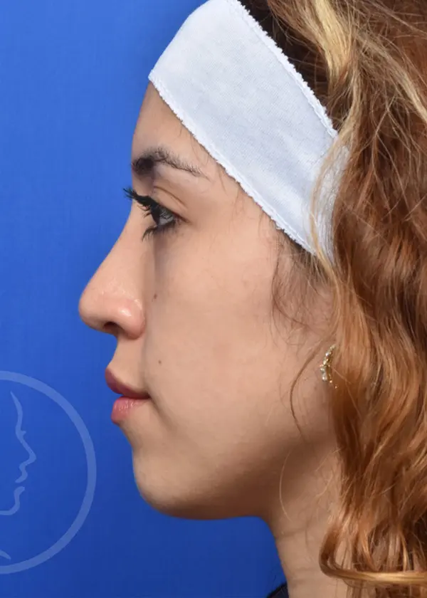 Plastic Surgery Before and After Pictures in Jacksonville, FL - Garcia Facial Plastic Surgery