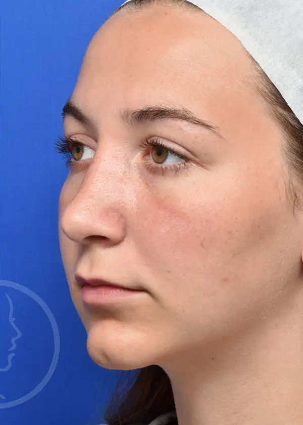 Plastic Surgery Before and After Pictures in Jacksonville, FL - Garcia Facial Plastic Surgery