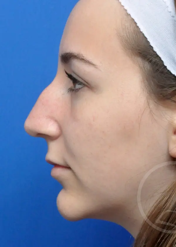 Plastic Surgery Before and After Pictures in Jacksonville, FL - Garcia Facial Plastic Surgery