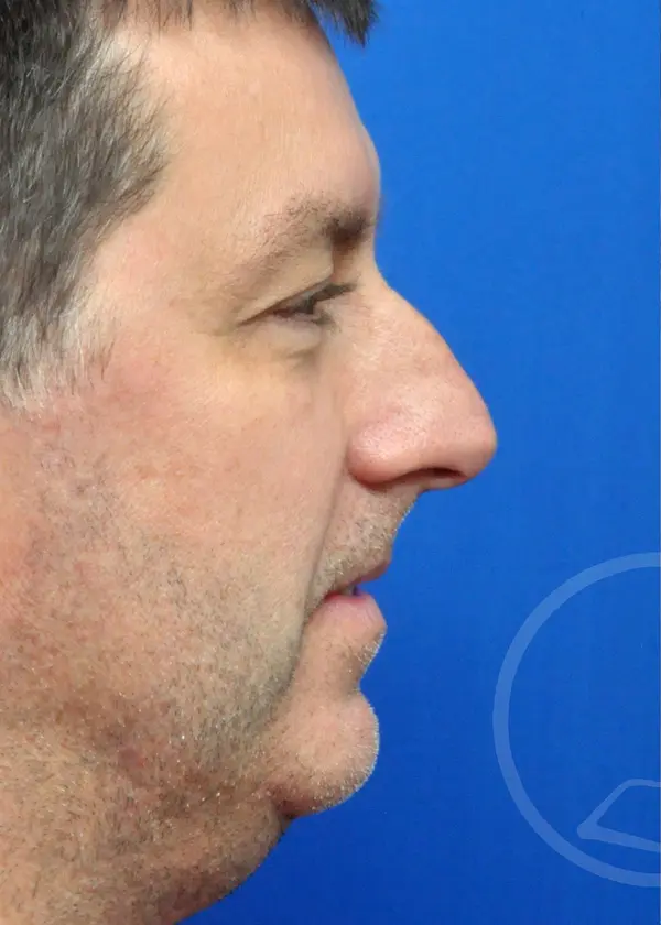 Plastic Surgery Before and After Pictures in Jacksonville, FL - Garcia Facial Plastic Surgery