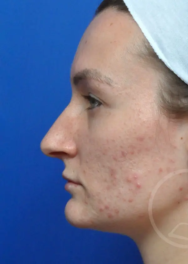 Plastic Surgery Before and After Pictures in Jacksonville, FL - Garcia Facial Plastic Surgery