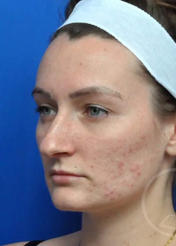 Plastic Surgery Before and After Pictures in Jacksonville, FL - Garcia Facial Plastic Surgery