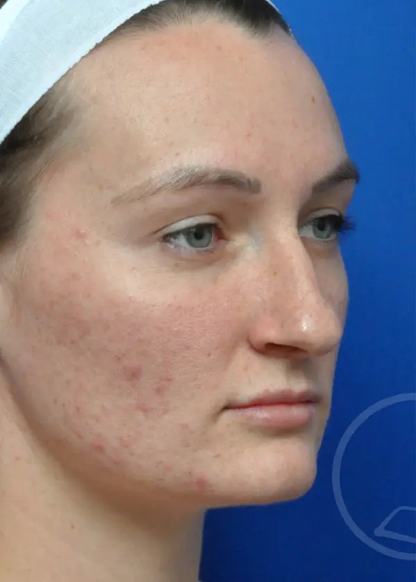 Plastic Surgery Before and After Pictures in Jacksonville, FL - Garcia Facial Plastic Surgery
