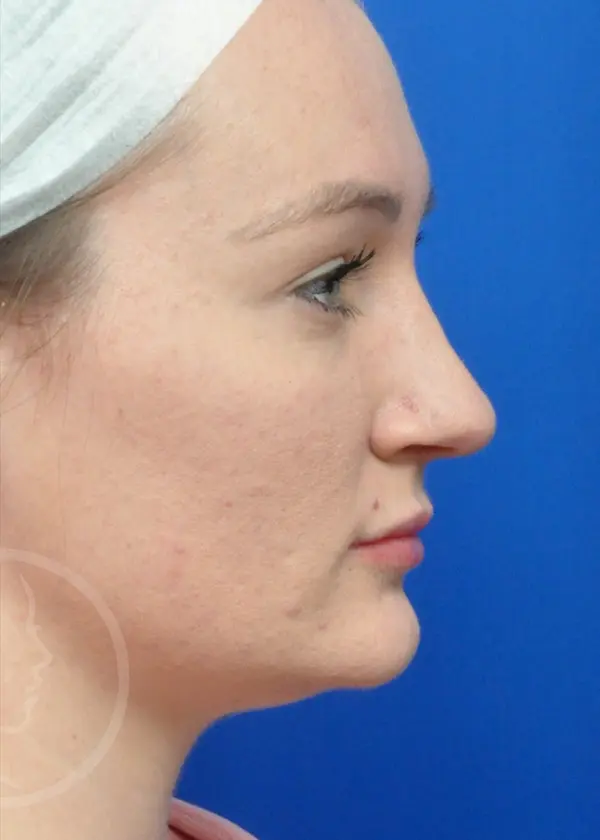 Plastic Surgery Before and After Pictures in Jacksonville, FL - Garcia Facial Plastic Surgery