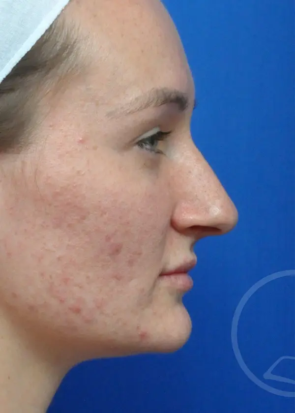 Plastic Surgery Before and After Pictures in Jacksonville, FL - Garcia Facial Plastic Surgery