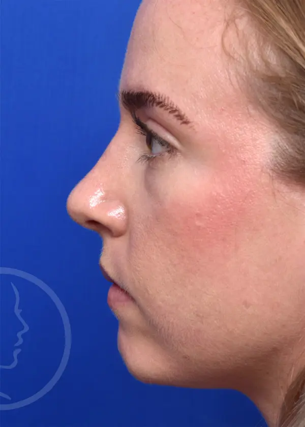 Plastic Surgery Before and After Pictures in Jacksonville, FL - Garcia Facial Plastic Surgery