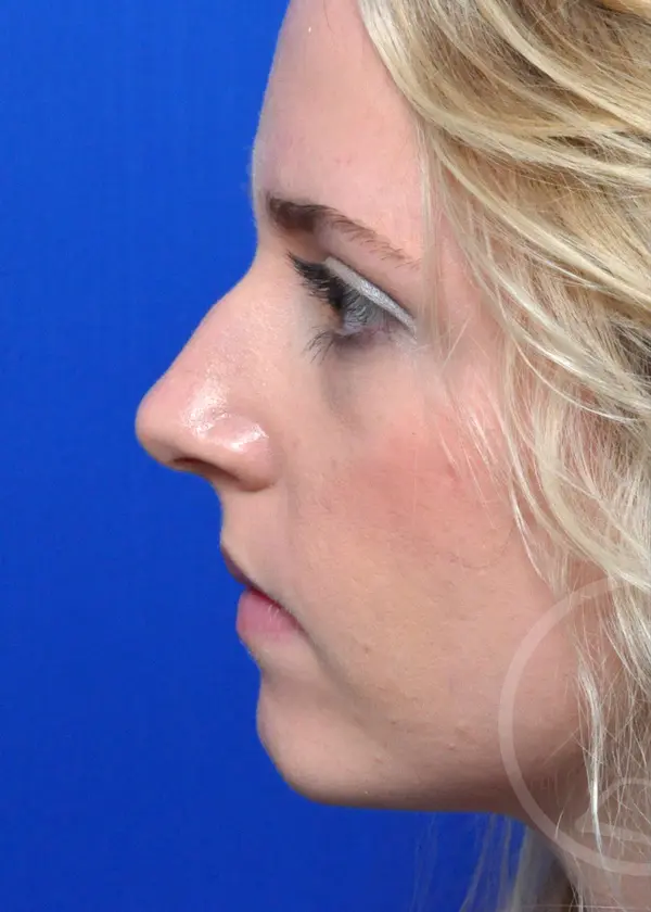 Plastic Surgery Before and After Pictures in Jacksonville, FL - Garcia Facial Plastic Surgery
