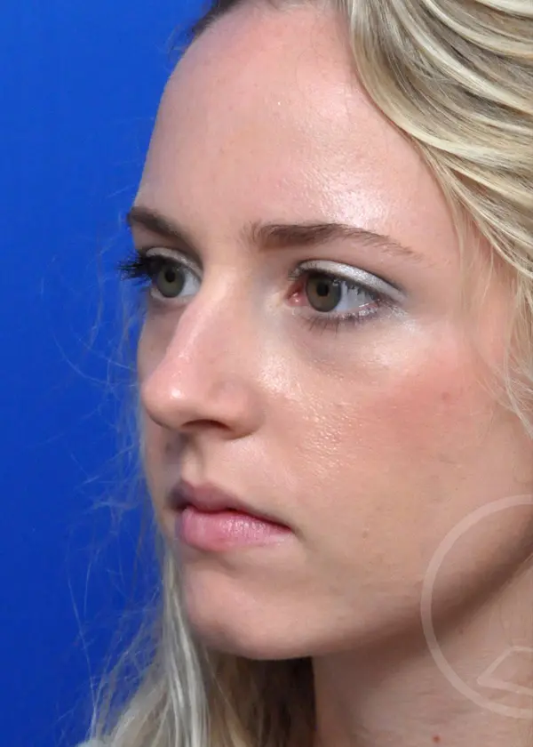 Plastic Surgery Before and After Pictures in Jacksonville, FL - Garcia Facial Plastic Surgery