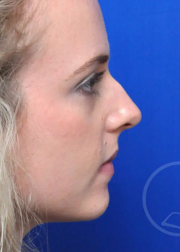 Plastic Surgery Before and After Pictures in Jacksonville, FL - Garcia Facial Plastic Surgery