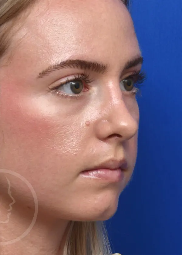 Plastic Surgery Before and After Pictures in Jacksonville, FL - Garcia Facial Plastic Surgery