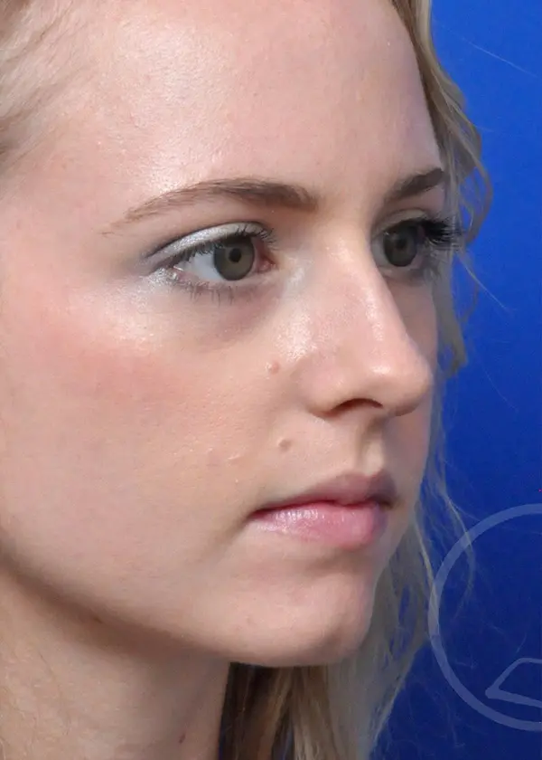 Plastic Surgery Before and After Pictures in Jacksonville, FL - Garcia Facial Plastic Surgery