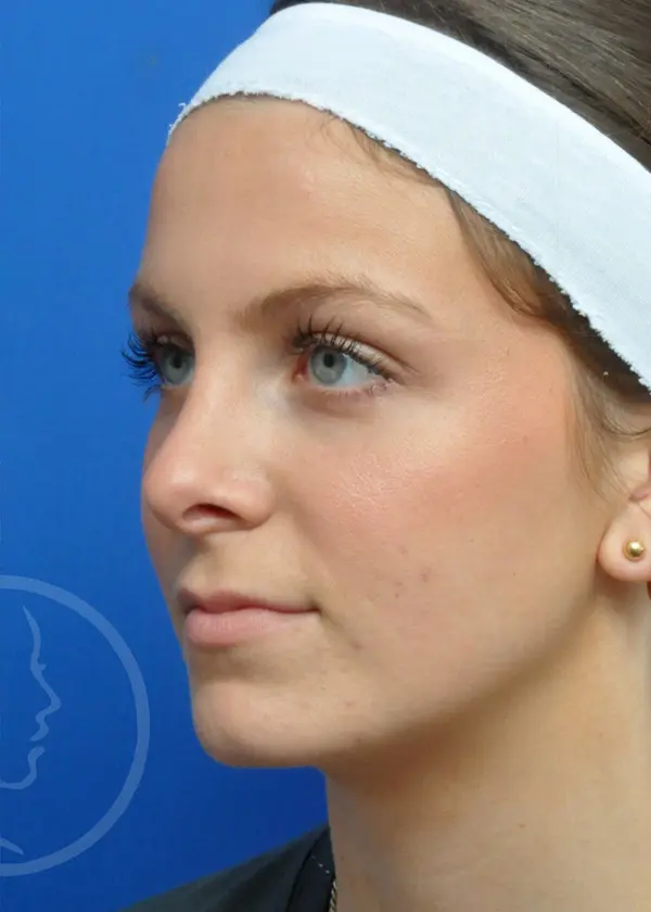 Plastic Surgery Before and After Pictures in Jacksonville, FL - Garcia Facial Plastic Surgery