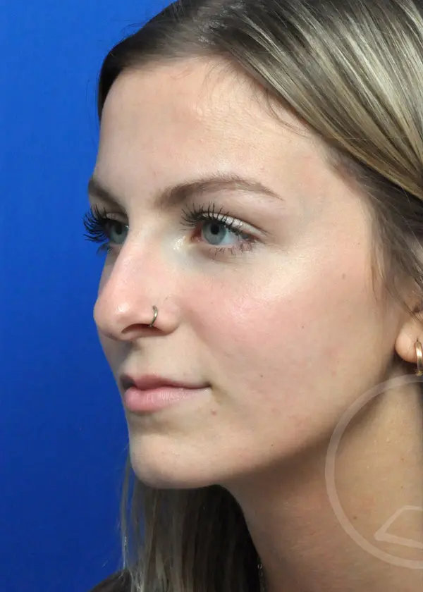 Plastic Surgery Before and After Pictures in Jacksonville, FL - Garcia Facial Plastic Surgery