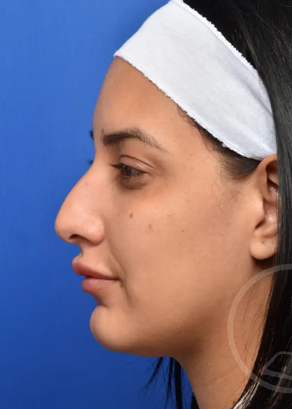 Plastic Surgery Before and After Pictures in Jacksonville, FL - Garcia Facial Plastic Surgery
