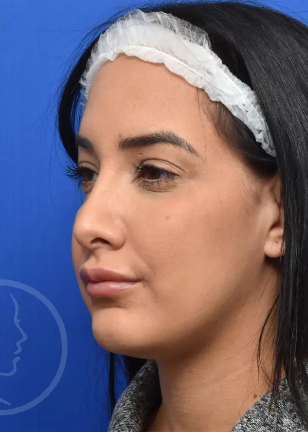 Plastic Surgery Before and After Pictures in Jacksonville, FL - Garcia Facial Plastic Surgery