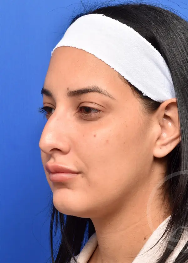 Plastic Surgery Before and After Pictures in Jacksonville, FL - Garcia Facial Plastic Surgery
