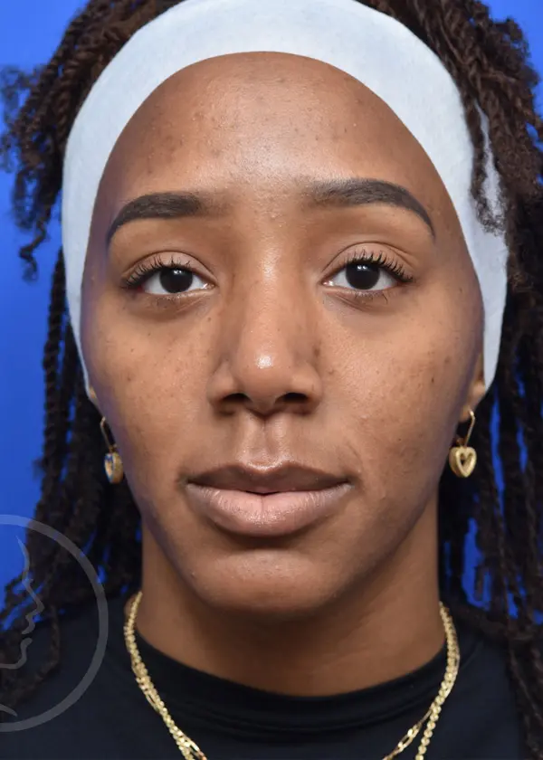 Plastic Surgery Before and After Pictures in Jacksonville, FL - Garcia Facial Plastic Surgery