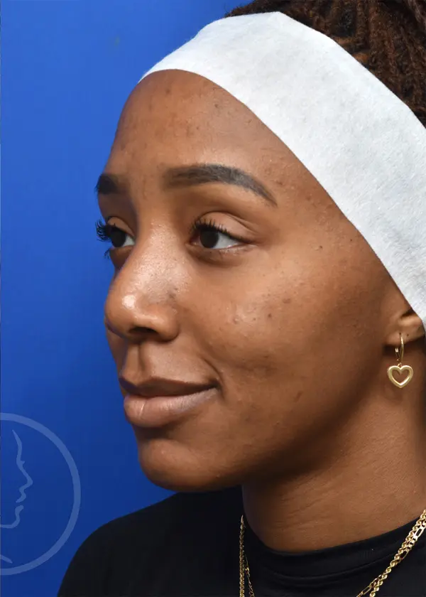 Plastic Surgery Before and After Pictures in Jacksonville, FL - Garcia Facial Plastic Surgery