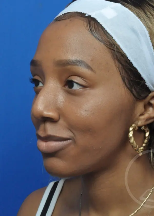 Plastic Surgery Before and After Pictures in Jacksonville, FL - Garcia Facial Plastic Surgery