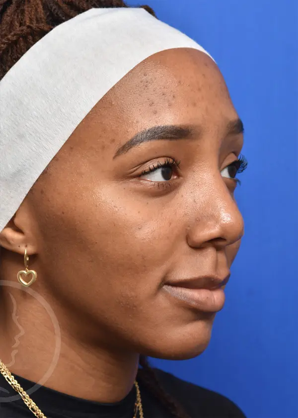 Plastic Surgery Before and After Pictures in Jacksonville, FL - Garcia Facial Plastic Surgery