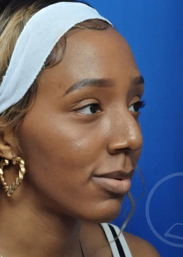 Plastic Surgery Before and After Pictures in Jacksonville, FL - Garcia Facial Plastic Surgery