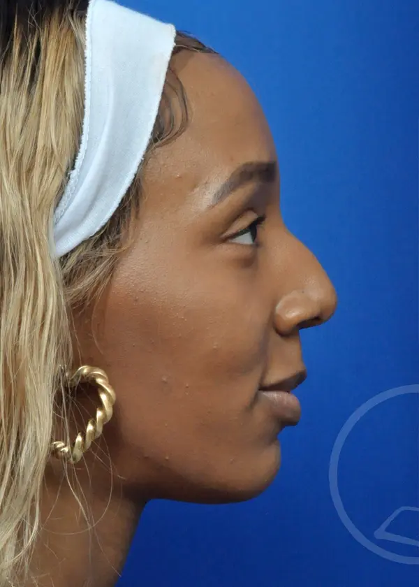 Plastic Surgery Before and After Pictures in Jacksonville, FL - Garcia Facial Plastic Surgery