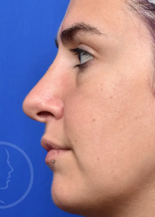 Plastic Surgery Before and After Pictures in Jacksonville, FL - Garcia Facial Plastic Surgery