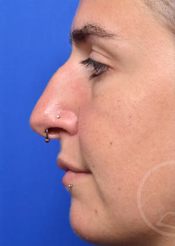 Plastic Surgery Before and After Pictures in Jacksonville, FL - Garcia Facial Plastic Surgery