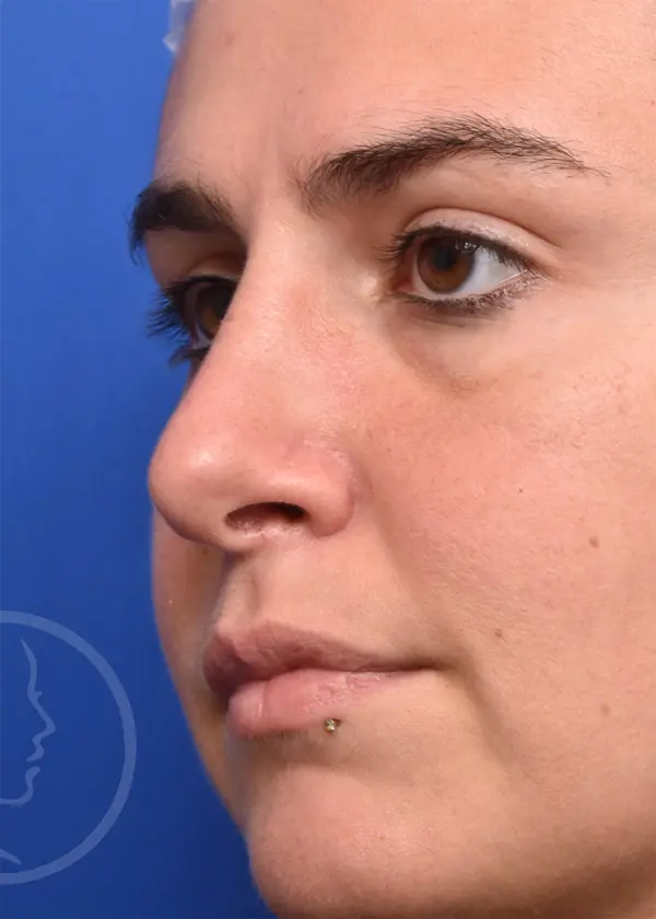 Plastic Surgery Before and After Pictures in Jacksonville, FL - Garcia Facial Plastic Surgery